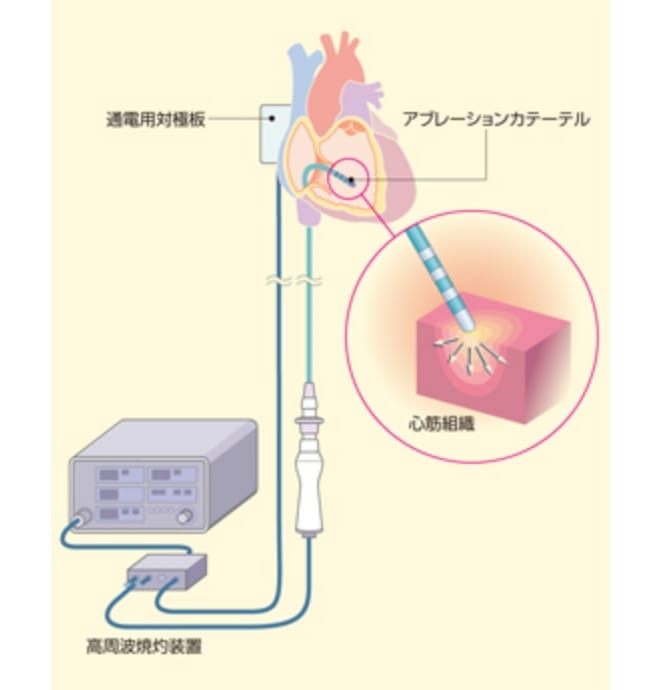 高周波通電によるアブレーション機器の説明