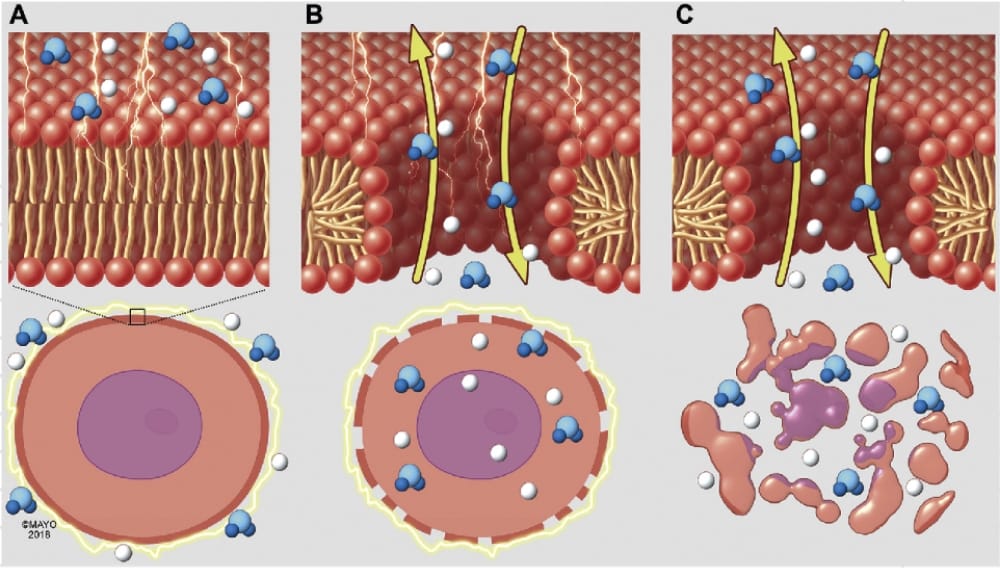 パルスフィールドアブレーションシステム治療イメージ02