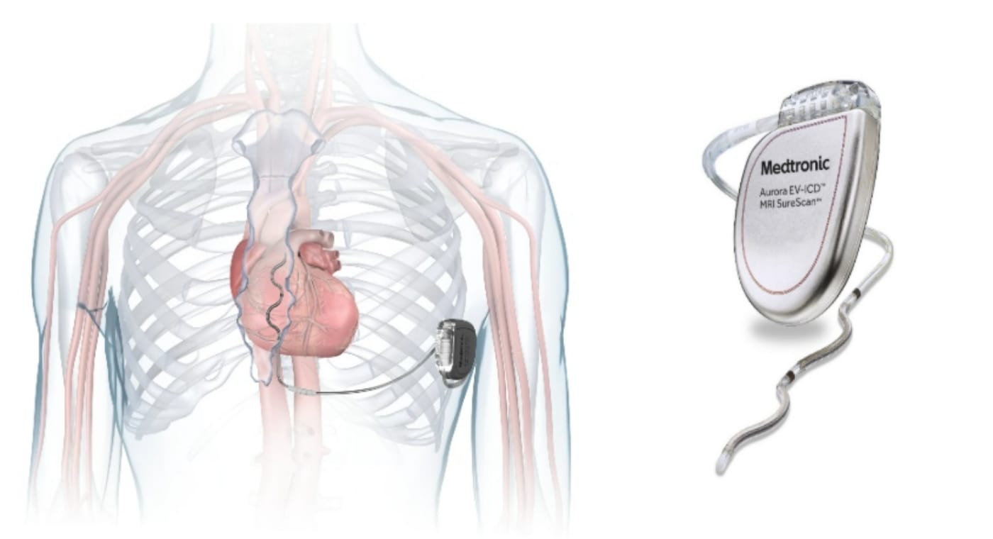 血管外植え込み型除細動器(EV-ICD)