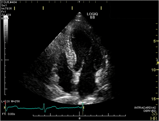 心臓の超音波画像