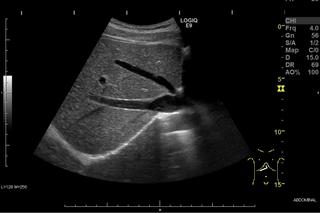 肝臓の超音波画像