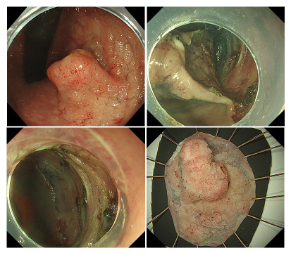 早期大腸癌に対する粘膜下層剥離術（ESD）