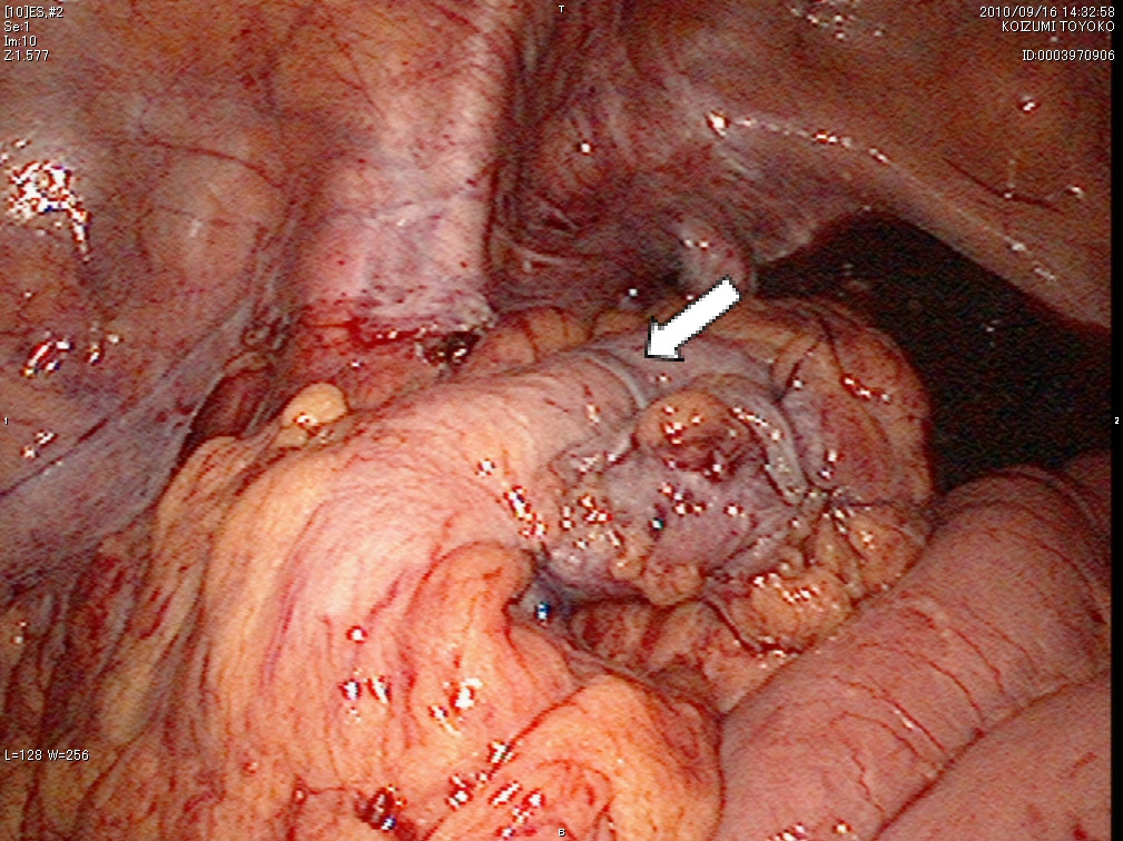 b）腸管吻合後状態（⇩）
