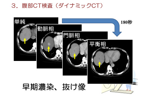 腹部CT検査（ダイナミックCT）