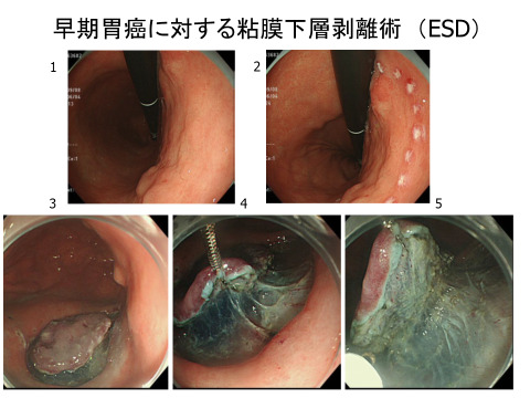 早期胃癌に対する粘膜下層剥離術（ESD）